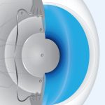 An Intraocular Collamer Lens shown in the cross-section of an eye